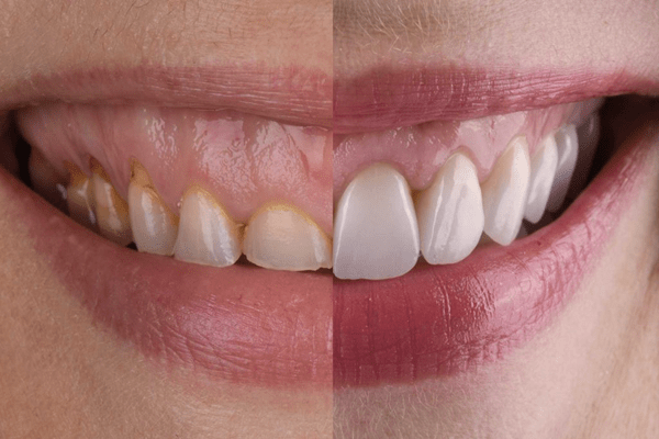 Dentalni Implanti