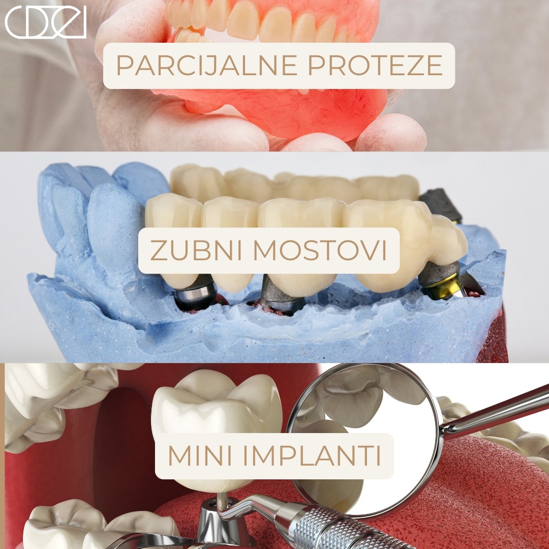 Najbolje-alternative-zubnim-implantatima