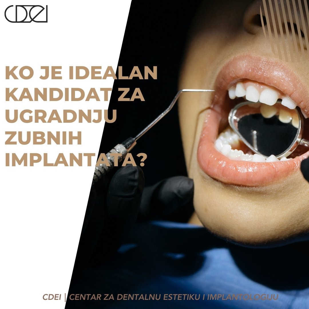 Ko je Idealan Kandidat za Ugradnju Zubnih Implantata?