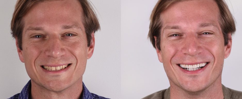 before-and-after-petar6