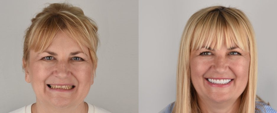 before-and-after_ljlja4