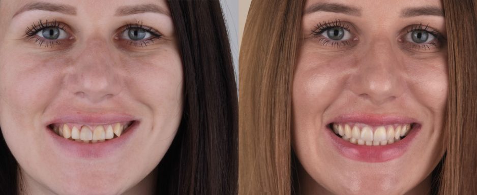 before-and-after_milica-1