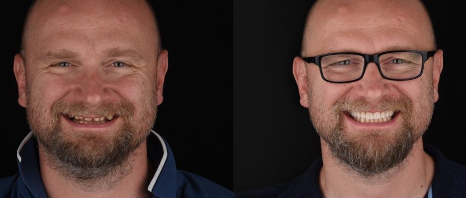 before-and-after_pedja4