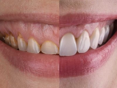 before_after_dentistry_cdei2