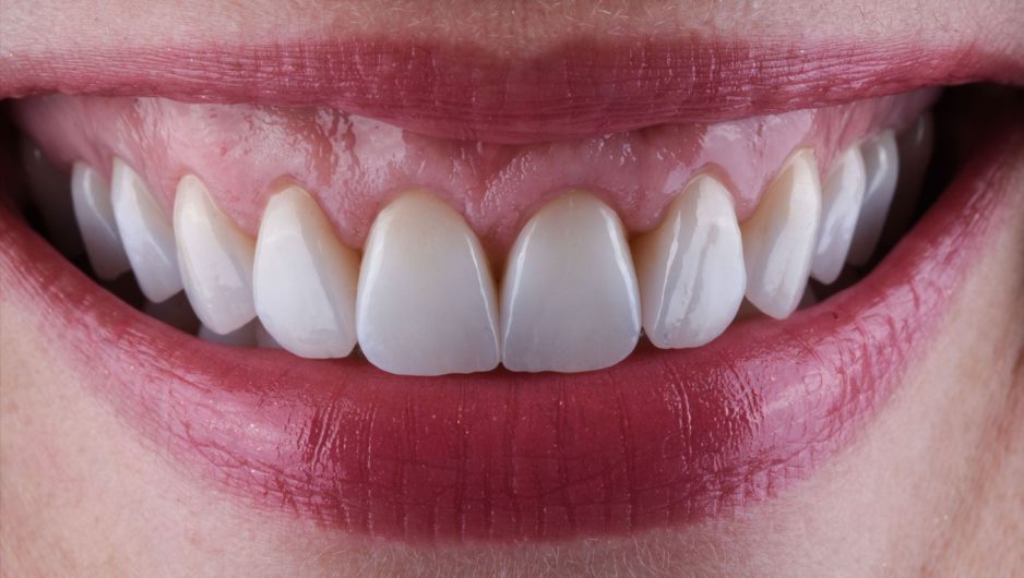 ceramic_veneers_aleksandra5