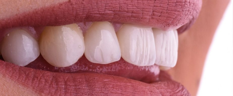 ceramic_veneers_detail