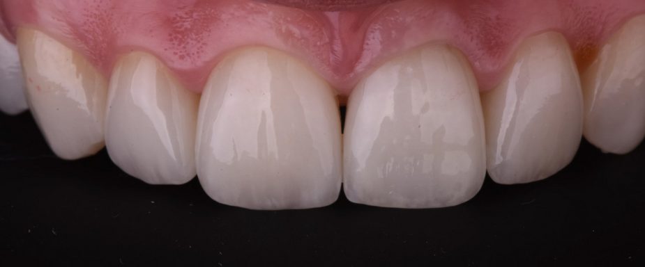 ceramic_veneers_ivana